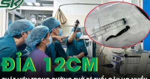 Bé 8 tuổi ho nhiều, bác sĩ phát hiện con đỉa dài hơn 12 cm trong đường thở