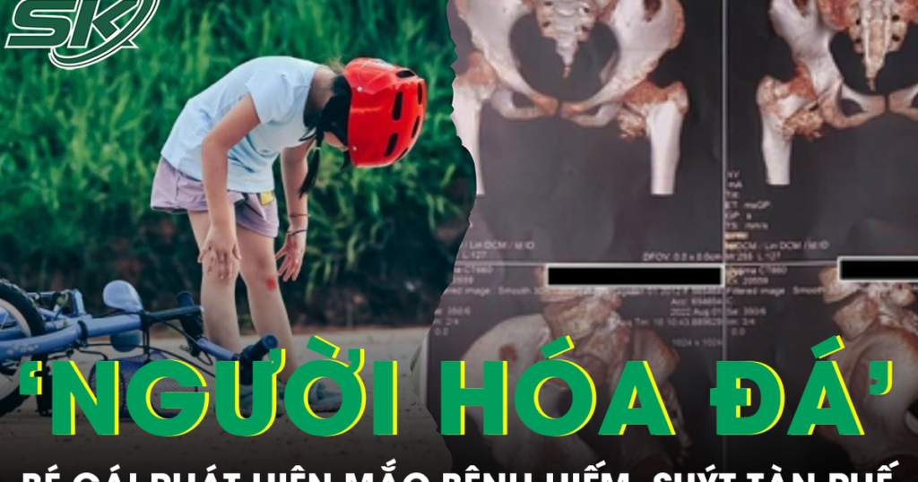 Bé gái cứng khớp suốt 2 năm sau cú ngã nhẹ, bác sĩ phát hiện mắc bệnh ‘người hóa đá’