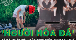 Bé gái cứng khớp suốt 2 năm sau cú ngã nhẹ, bác sĩ phát hiện mắc bệnh ‘người hóa đá’