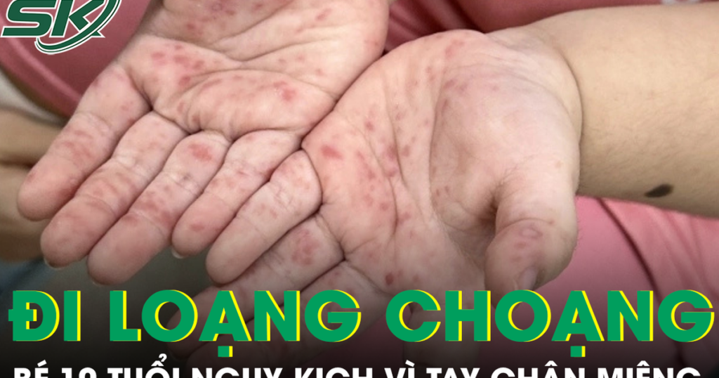 Tưởng bệnh nhẹ, bé gái 10 tuổi nhập viện nguy kịch vì tay chân miệng biến chứng thần kinh