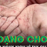 Tưởng bệnh nhẹ, bé gái 10 tuổi nhập viện nguy kịch vì tay chân miệng biến chứng thần kinh