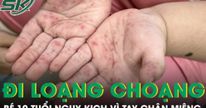 Tưởng bệnh nhẹ, bé gái 10 tuổi nhập viện nguy kịch vì tay chân miệng biến chứng thần kinh