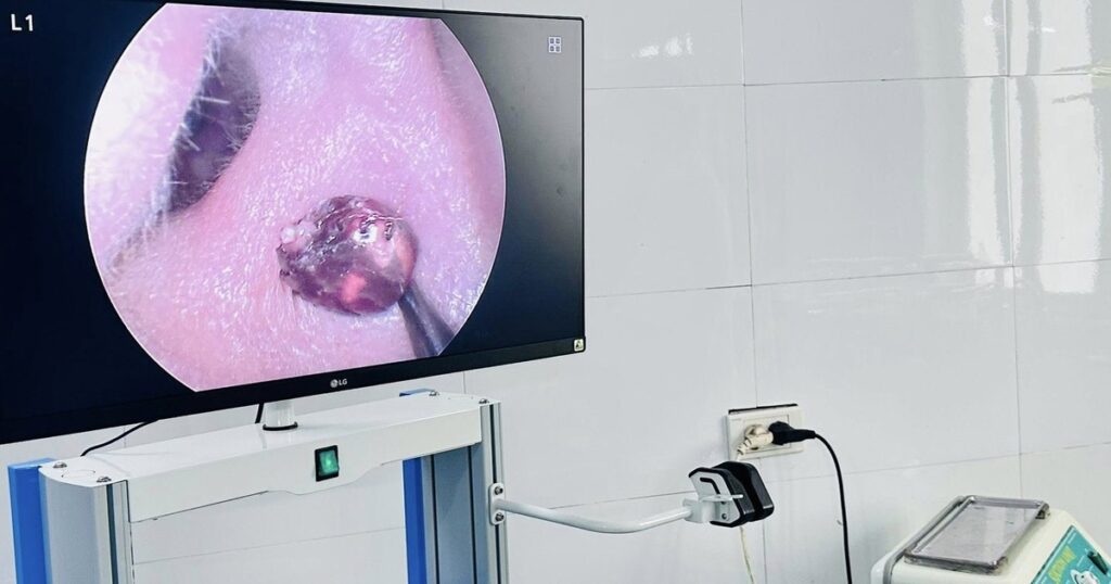 Đau nhức tai suốt một tuần, người phụ nữ tá hỏa vì ‘vị khách lạ’ trong tai