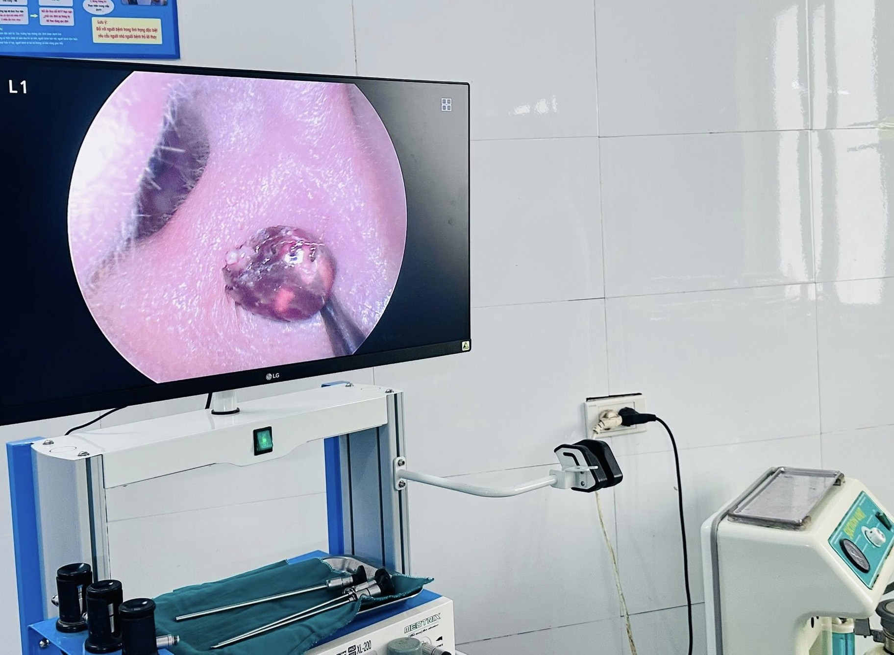 Đau nhức tai suốt một tuần, người phụ nữ tá hỏa vì 'vị khách lạ' trong tai- Ảnh 1.