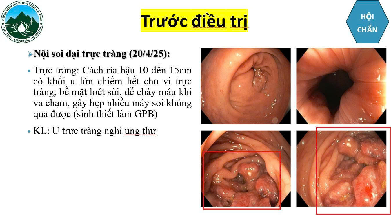 anh-1-17785743270891678311320 Bệnh viện Đa khoa Hà Tĩnh điều trị thành công cho bệnh nhân ung thư trực tràng di căn gan giai đoạn 4- Ảnh 1.