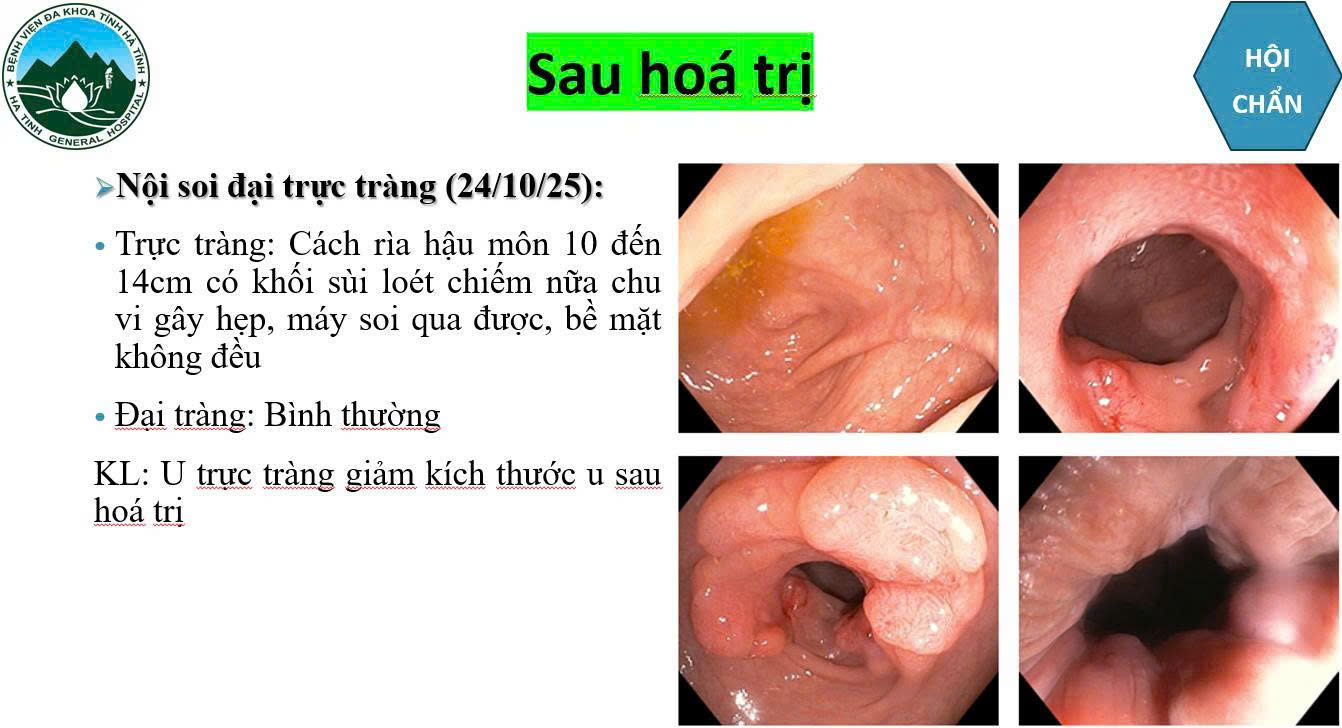anh-2-1778574326998269355021 Bệnh viện Đa khoa Hà Tĩnh điều trị thành công cho bệnh nhân ung thư trực tràng di căn gan giai đoạn 4- Ảnh 2.