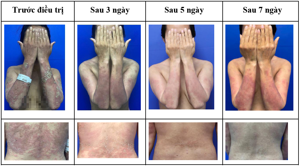 Vảy nến thể mủ toàn thân đợt cấp - Căn bệnh không lây nhưng nguy hiểm- Ảnh 2.