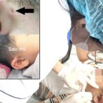 Hi hữu ca rò luân nhĩ di truyền qua 3 thế hệ