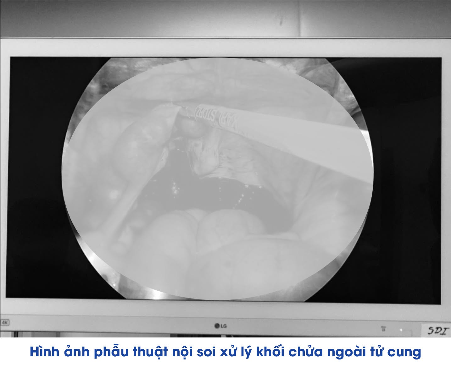 Liên tiếp cứu sống nhiều phụ nữ chửa ngoài tử cung vỡ tại Bệnh viện Đa khoa Khu vực Vân Đồn - Ảnh 2.
