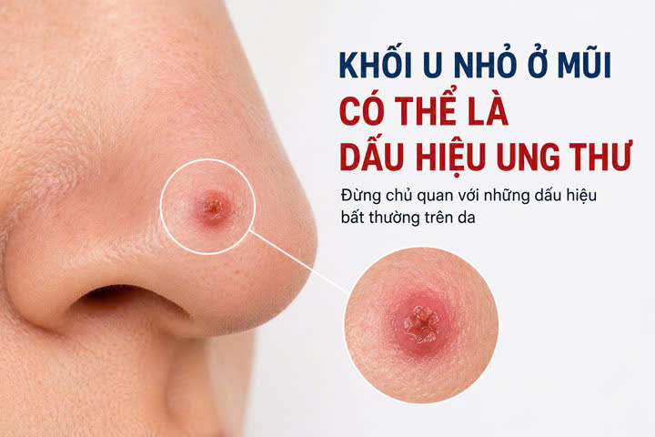 khoi-u-nho-o-mui-co-the-la-dau-hieu-ung-thu-1780485735915899719950 Cảnh báo ung thư da núp bóng những tổn thương tưởng chừng vô hại- Ảnh 1.