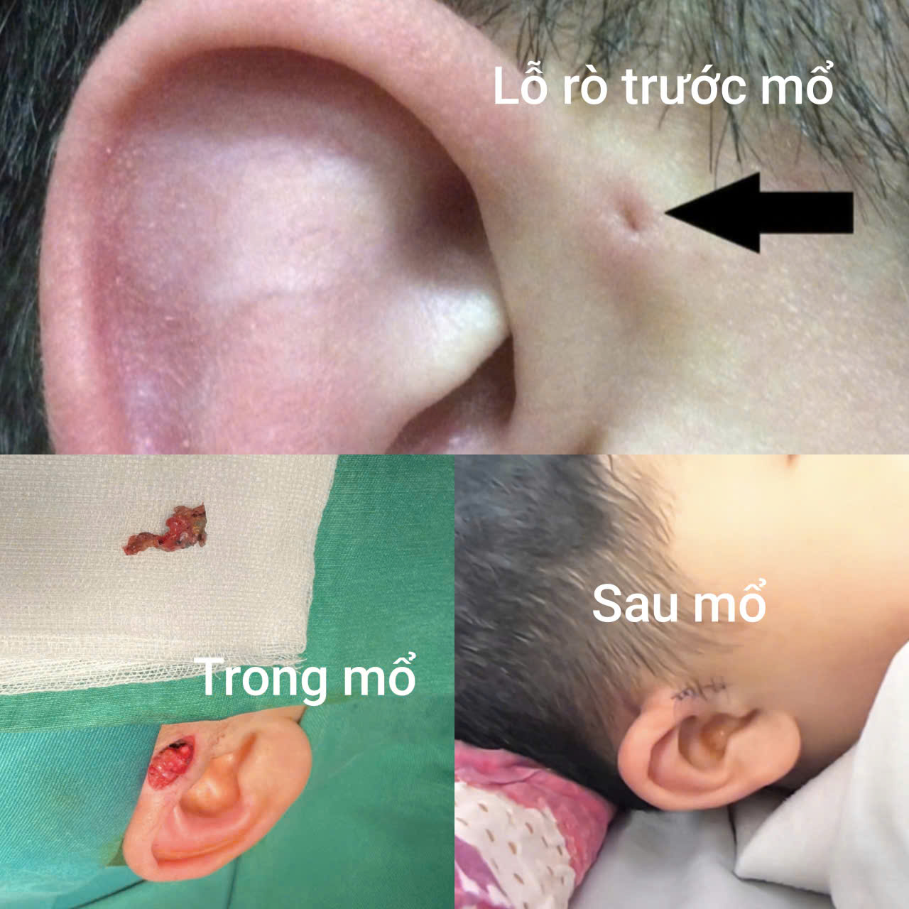 luan-nhi-1779784515593650683247 Hi hữu ca rò luân nhĩ di truyền qua 3 thế hệ- Ảnh 2.