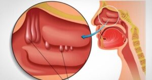 Nghẹt mũi, khó thở là biểu hiện của bệnh gì?