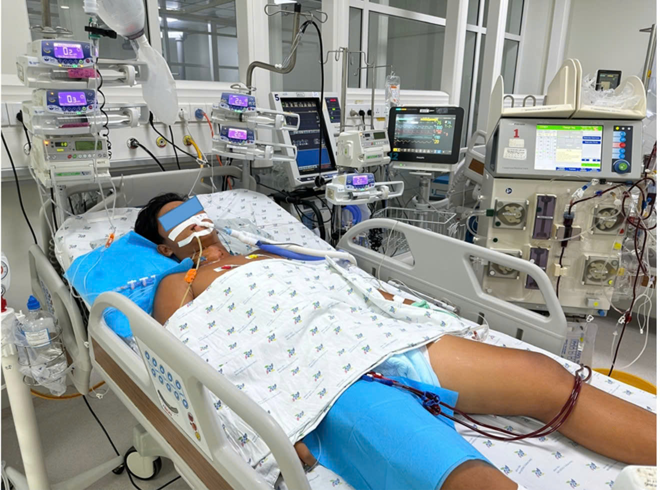 soc-nhiet-17796763011171732199839 Đá bóng dưới trời nắng, bé trai sốc nhiệt biến chứng huỷ cơ, suy đa cơ quan- Ảnh 1.