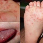 Khánh Hòa đã ghi nhận 2.254 ca tay chân miệng, bác sĩ khuyến cáo điều cần nhớ để phòng bệnh