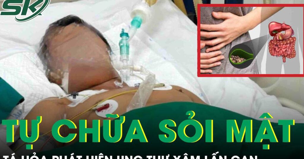 Tự chữa sỏi mật tại nhà, người đàn ông tá hỏa phát hiện ung thư xâm lấn gan