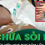 Tự chữa sỏi mật tại nhà, người đàn ông tá hỏa phát hiện ung thư xâm lấn gan