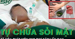 Tự chữa sỏi mật tại nhà, người đàn ông tá hỏa phát hiện ung thư xâm lấn gan