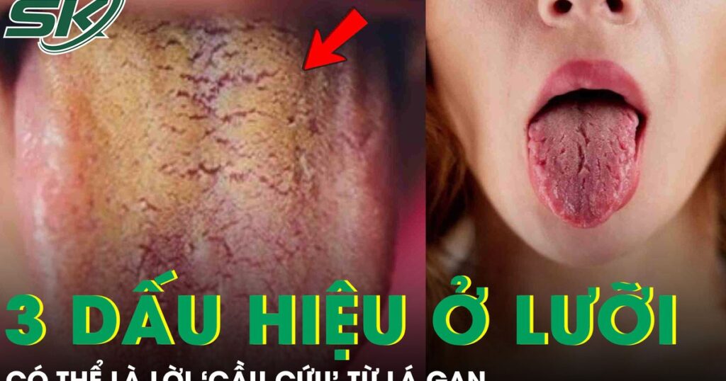 Đừng bỏ qua 3 dấu hiệu bất thường này trên lưỡi, có thể là lời ‘cầu cứu’ từ lá gan