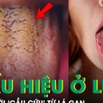 Đừng bỏ qua 3 dấu hiệu bất thường này trên lưỡi, có thể là lời ‘cầu cứu’ từ lá gan