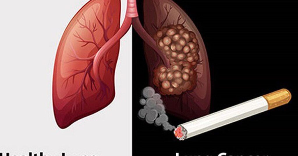 Thuốc lá gây ra 90% các trường hợp ung thư phổi