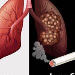 Thuốc lá gây ra 90% các trường hợp ung thư phổi