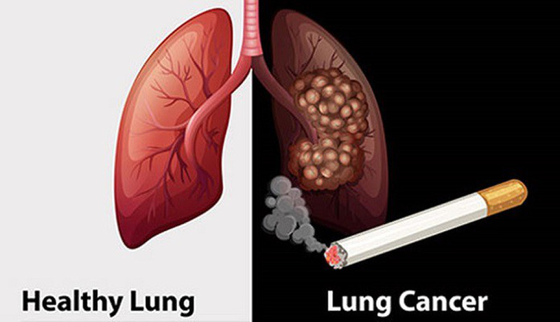Thuốc lá gây ra 90% các trường hợp ung thư phổi- Ảnh 1.