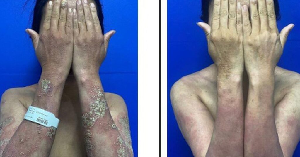 Người phụ nữ mắc vảy nến chi chít mụn mủ, kháng phác đồ điều trị truyền thống