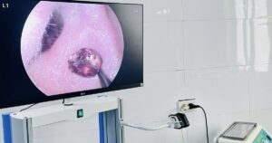 Đau nhức tai suốt một tuần, người phụ nữ tá hỏa vì ‘vị khách lạ’ trong tai